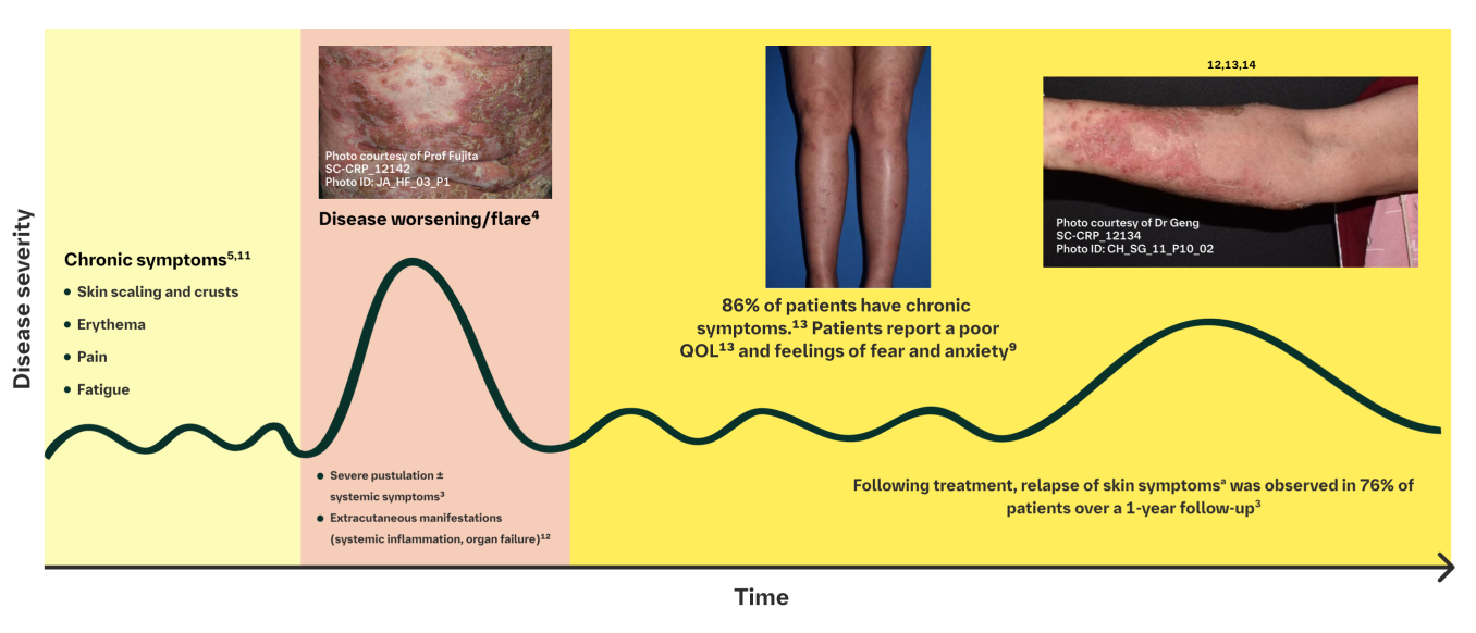 GPP Disease Severity Over Time