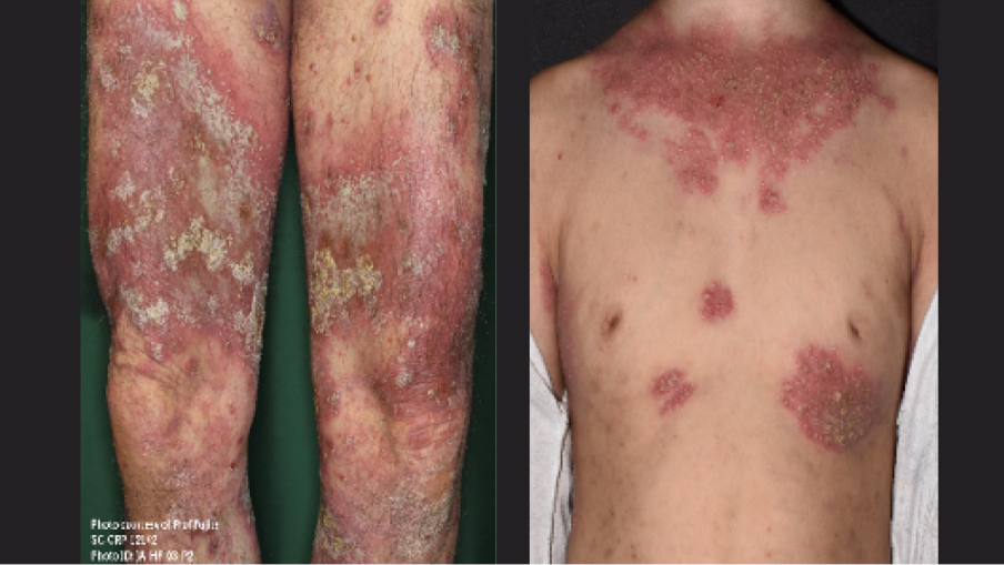 Presentation of Generalized Pustular Psoriasis (GPP)